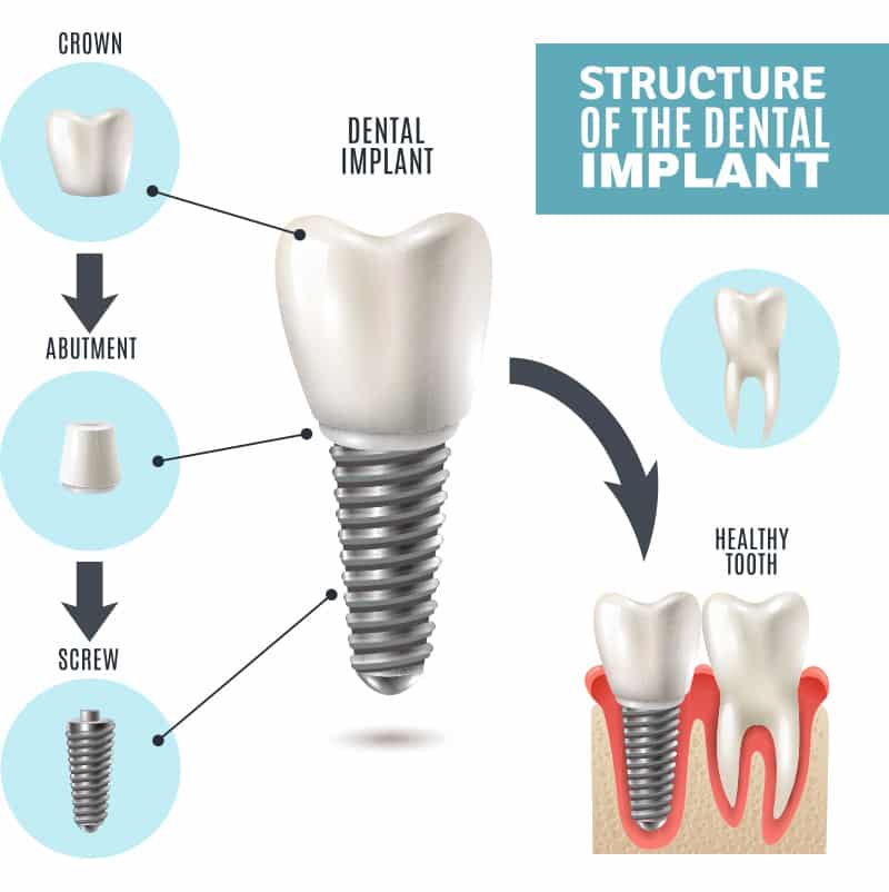 dental implant services