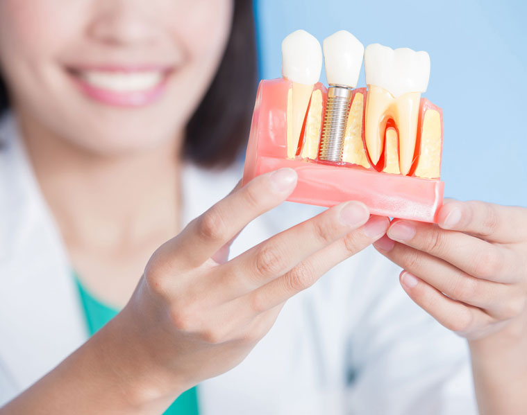 All-on-4 Implants
